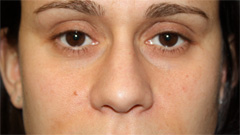 Rhinoplasty Before & After Patient #22207