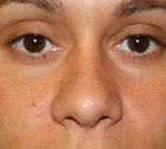 Rhinoplasty Before & After Patient #22207