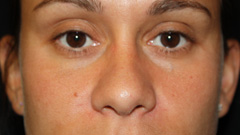 Rhinoplasty Before & After Patient #22207
