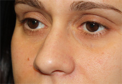 Rhinoplasty Before & After Patient #22207