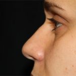 Rhinoplasty Before & After Patient #22207