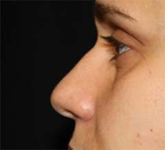 Rhinoplasty Before & After Patient #22207