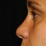 Rhinoplasty Before & After Patient #22207