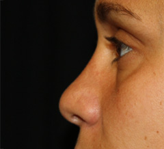 Rhinoplasty Before & After Patient #22207