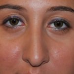 Rhinoplasty Before & After Patient #22214