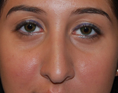Rhinoplasty Before & After Patient #22214