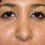 Rhinoplasty Before & After Patient #22214