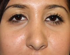 Rhinoplasty Before & After Patient #22214