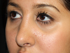 Rhinoplasty Before & After Patient #22214