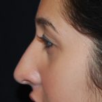 Rhinoplasty Before & After Patient #22214