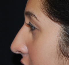 Rhinoplasty Before & After Patient #22214