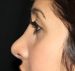 Rhinoplasty Before & After Patient #22214