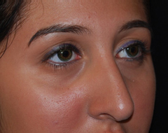 Rhinoplasty Before & After Patient #22214