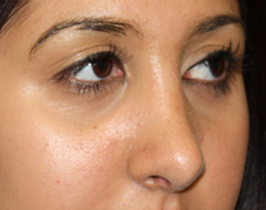 Rhinoplasty Before & After Patient #22214