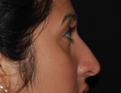 Rhinoplasty Before & After Patient #22214