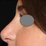 Rhinoplasty Before & After Patient #22225