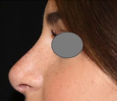 Rhinoplasty Before & After Patient #22225