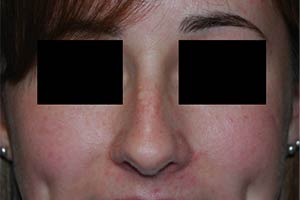 Rhinoplasty Before & After Patient #22237