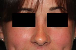 Rhinoplasty Before & After Patient #22237