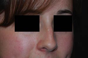 Rhinoplasty Before & After Patient #22237