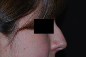 Rhinoplasty Before & After Patient #22237