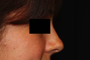 Rhinoplasty Before & After Patient #22237