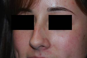 Rhinoplasty Before & After Patient #22237