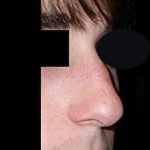 Rhinoplasty Before & After Patient #22274