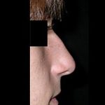 Rhinoplasty Before & After Patient #22274