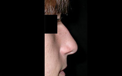 Rhinoplasty Before & After Patient #22274