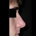 Rhinoplasty Before & After Patient #22274