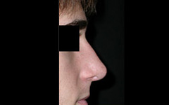 Rhinoplasty Before & After Patient #22274