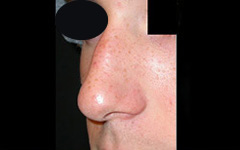 Rhinoplasty Before & After Patient #22274