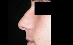 Rhinoplasty Before & After Patient #22274