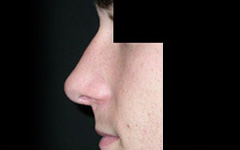 Rhinoplasty Before & After Patient #22274