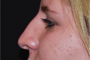 Rhinoplasty Before & After Patient #22284