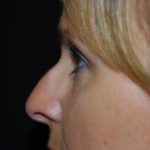 Rhinoplasty Before & After Patient #22295