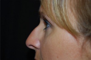 Rhinoplasty Before & After Patient #22295