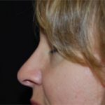 Rhinoplasty Before & After Patient #22295