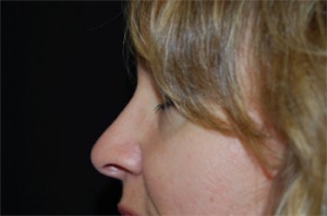 Rhinoplasty Before & After Patient #22295