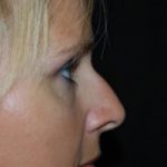 Rhinoplasty Before & After Patient #22295