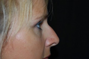 Rhinoplasty Before & After Patient #22295