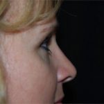 Rhinoplasty Before & After Patient #22295