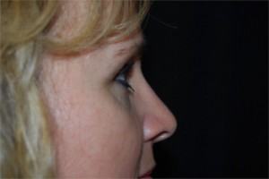 Rhinoplasty Before & After Patient #22295