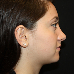 Rhinoplasty Before & After Patient #22313