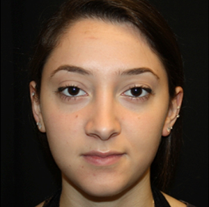 Rhinoplasty Before & After Patient #22313