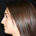 Rhinoplasty Before & After Patient #22313