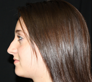 Rhinoplasty Before & After Patient #22313