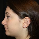 Rhinoplasty Before & After Patient #22313