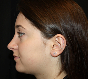 Rhinoplasty Before & After Patient #22313